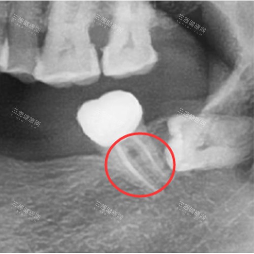 根管治疗后的牙齿
