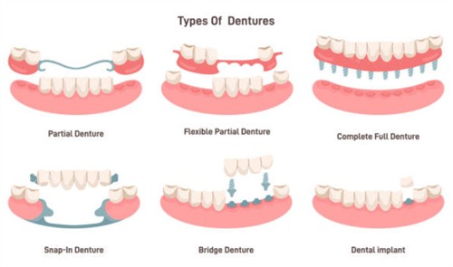 牙齿缺失示意图