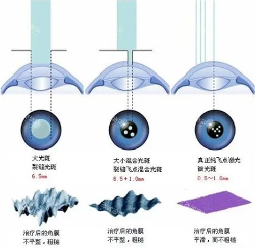 近视手术对比