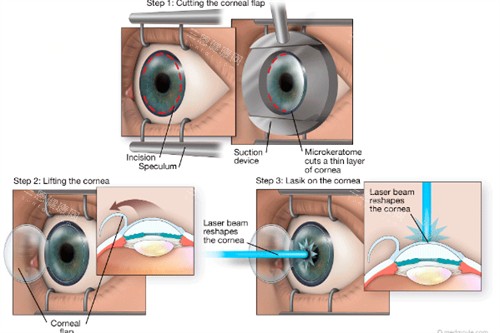 近视手术操作过程图解