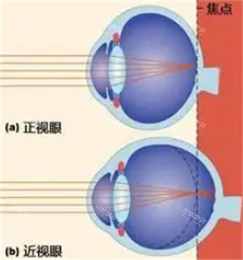正常眼睛和近视眼镜的不同