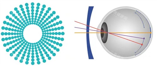 奥拉怒放离焦镜片原理