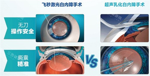 飞秒激光白内障手术和超声乳化白内障手术区别