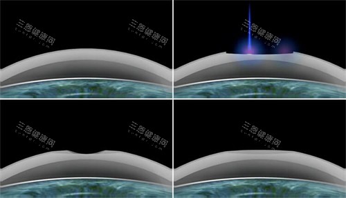 smart激光近视手术过程 smart激光近视手术过程