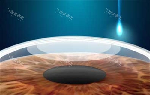 smart全激光近视手术 smart全激光近视手术