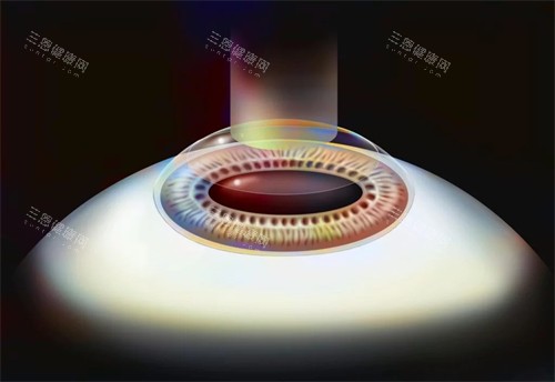 smart激光近视手术演示