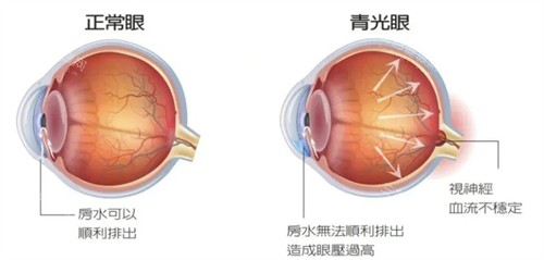 正常眼睛和青光眼的不同之处