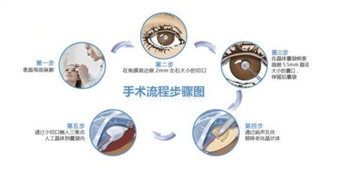 白内障三焦点人工晶体手术过程