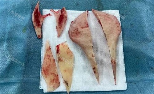 磨骨手术切掉的骨头