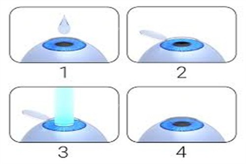 重庆合川爱成眼科预约挂号超顺畅！多渠道可选，旺季提前排期，不耽误诊疗
