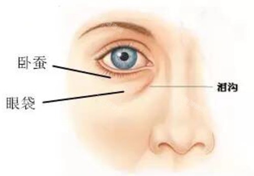 眼下卧蚕泪沟及眼袋对比示意图