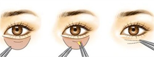 内切法祛眼袋的手术步骤