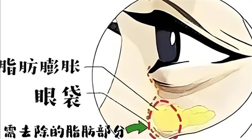 梁伟中眼周复位手术三个月过程全记录：眼袋泪沟综合年轻化方案及术后日常护理秘籍分享！