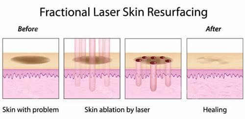 激光祛斑流程图