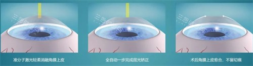 近视手术简要流程