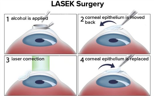 近视手术过程 近视手术过程