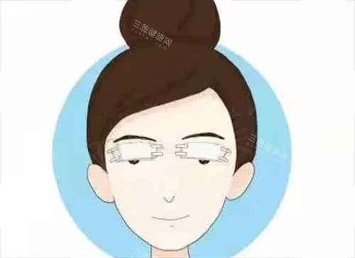 双眼皮术后 双眼皮术后