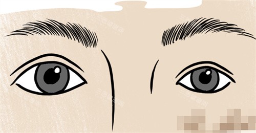 双眼皮大小眼修复 双眼皮大小眼修复