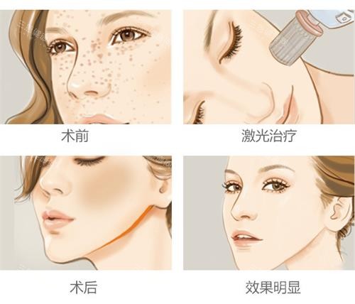 激光祛斑的过程 激光祛斑的过程