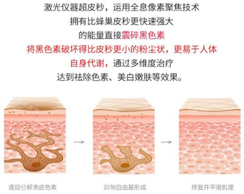 激光祛斑前后的对比 激光祛斑前后的对比