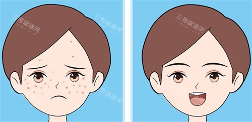 激光祛斑对比 激光祛斑对比