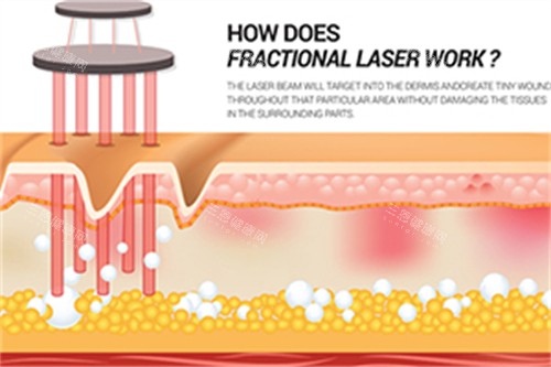 激光在皮肤中祛斑 激光在皮肤中祛斑