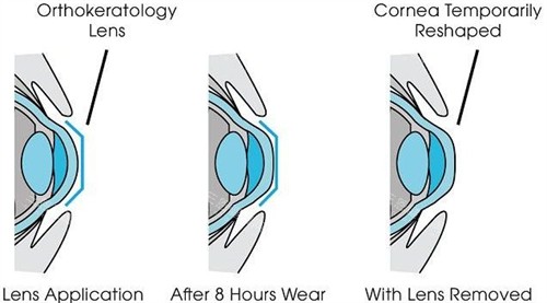 角膜塑形镜矫正眼睛流程图 角膜塑形镜矫正眼睛流程图