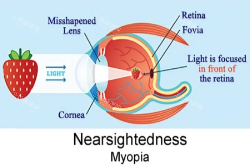 近视视物落在视网膜前 近视视物落在视网膜前