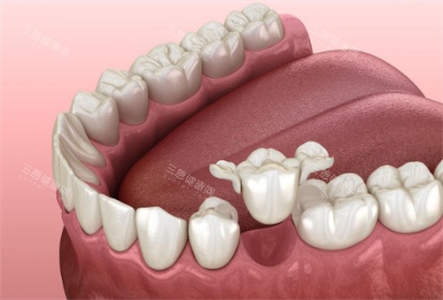 牙齿修复动画展示图