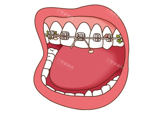 牙齿矫正牙套口腔漫画图 牙齿矫正牙套口腔漫画图