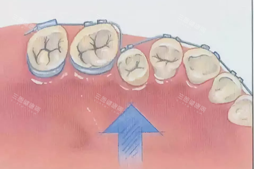 牙齿矫正示意图 牙齿矫正示意图