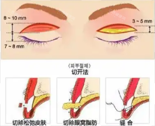 切开双眼皮手术