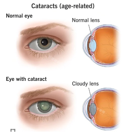正常眼睛和白内障眼睛 正常眼睛和白内障眼睛