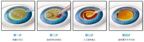 超声乳化白内障手术流程图