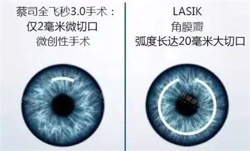 蔡司全飞秒3.0手术和LASIK对比 蔡司全飞秒3.0手术和LASIK对比