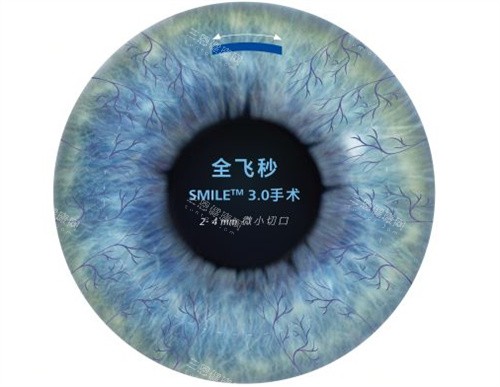 贵州省人民医院做飞秒手术价格是多少钱？半飞秒1.2万起，全飞秒1.8万起！