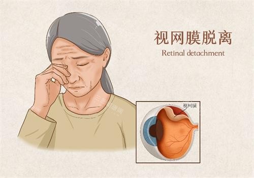 视网膜脱落示意图.