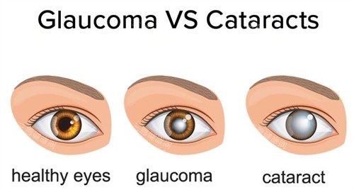 正常眼睛白内障和青光眼