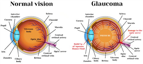 正常眼睛和青光眼的对比图