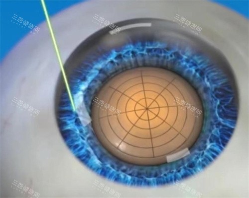 飞秒激光白内障手术图