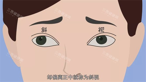 昆明红会医院做斜视矫正手术费用是多少？一份详尽的费用指南给到大家！