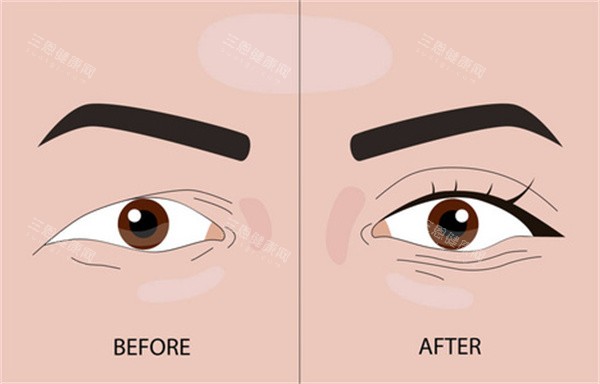 埋线双眼皮整形