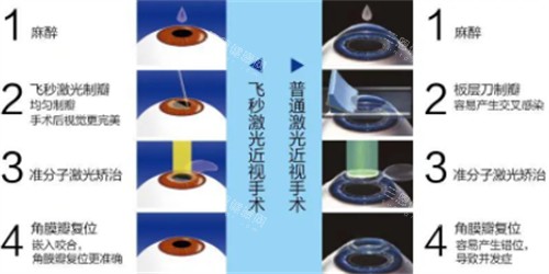 飞秒近视手术与激光近视手术的过程区别图解 飞秒近视手术与激光近视手术的过程区别图解