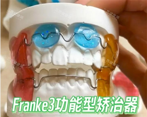 法兰克3矫正器模型
