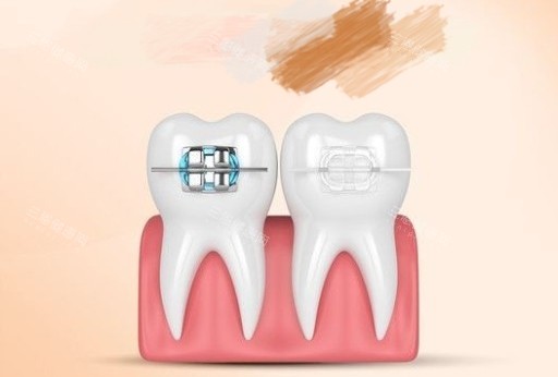 牙齿矫正金属和陶瓷托槽漫画图 牙齿矫正金属和陶瓷托槽漫画图