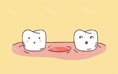 缺牙示意图