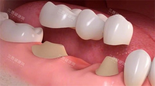缺牙使用桥冠修复