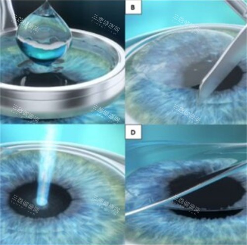 近视手术过程 近视手术过程