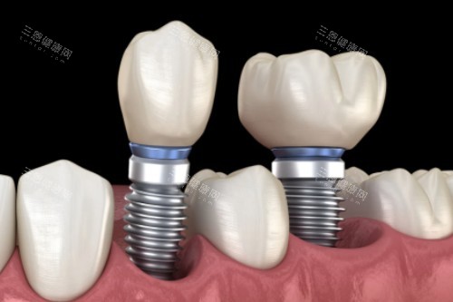 种植牙修复卡通一览 种植牙修复卡通一览