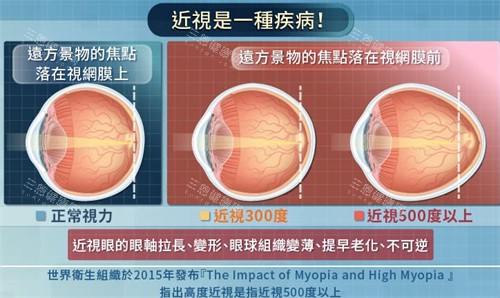 不同程度近视的眼球变化图解